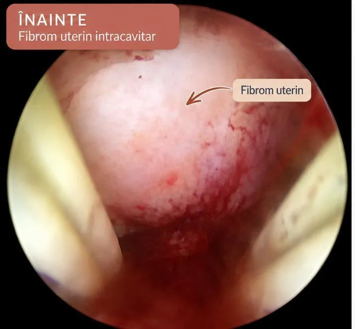 Fibrom uterin intracavitar FIGO 0 — aspect înainte de miomectomie histeroscopică